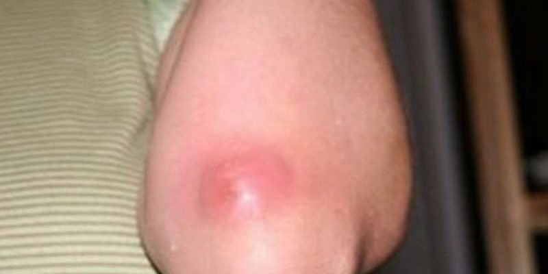 Ano ang mga sintomas ng pigsa o boils?