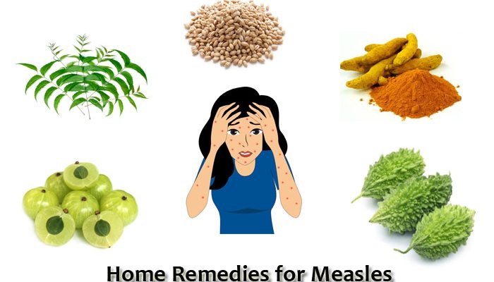 Paano maka-iwas sa tigdas o measles?