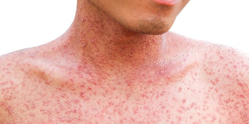 Ano ang gamot sa tigdas o measles?