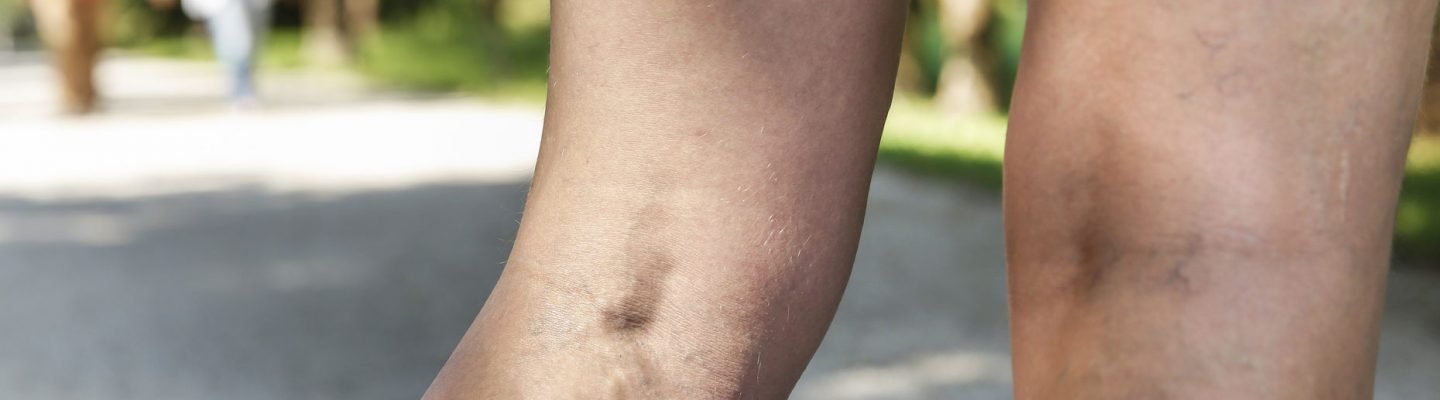 Kaalaman Tungkol sa Varicose Veins o mga Nakalitaw na Ugat
