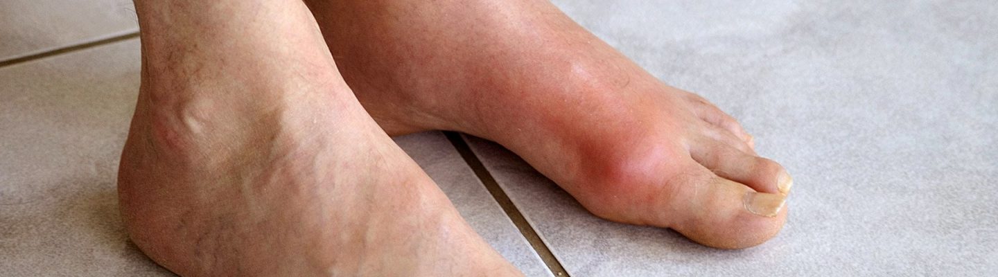 Mataas na Uric Acid: Mga Kaalaman