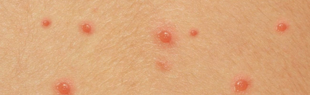 Bulutong (Chickenpox)