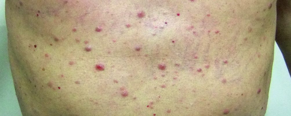 Ano ang mga sintomas ng leukemia?