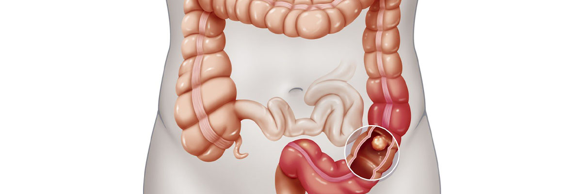 Kanser sa Malaking Bituka (Colon Cancer)