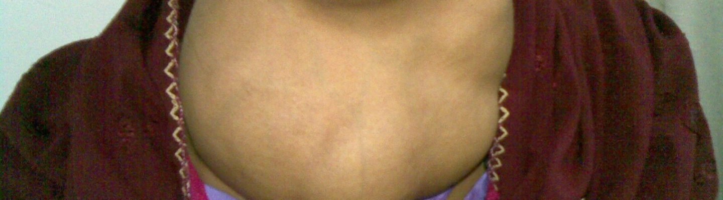Bosyo (Goiter)