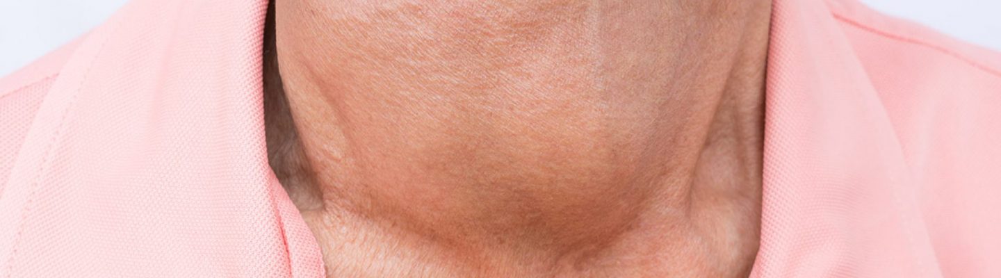 Hyperthyroidism