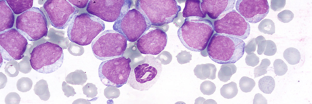 Leukemia (Kanser sa Dugo)