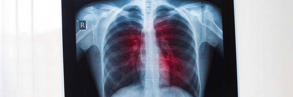 Kanser sa Baga (Lung Cancer)