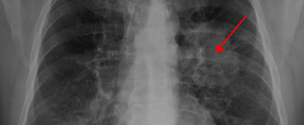 Kanser sa Baga (Lung Cancer)