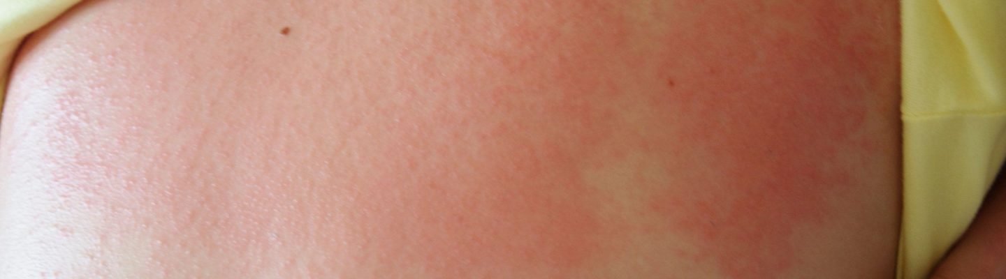 Bungang Araw (Prickly Heat Rash)