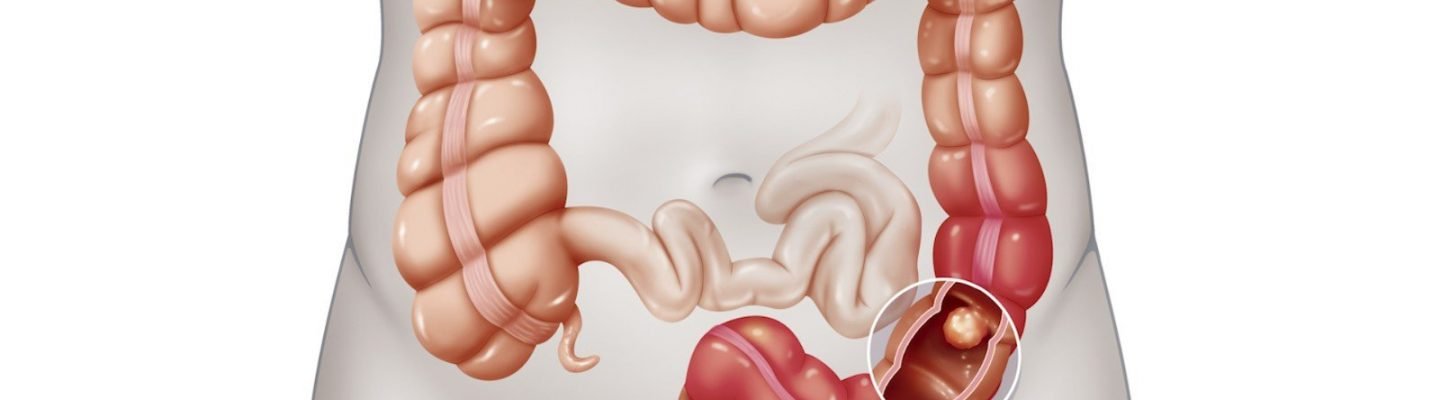 Kanser sa Malaking Bituka (Colon Cancer)