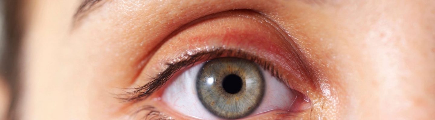 Glaucoma