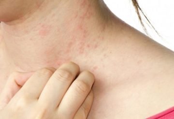 neck allergy