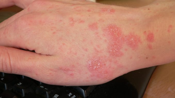 Galis (Scabies)