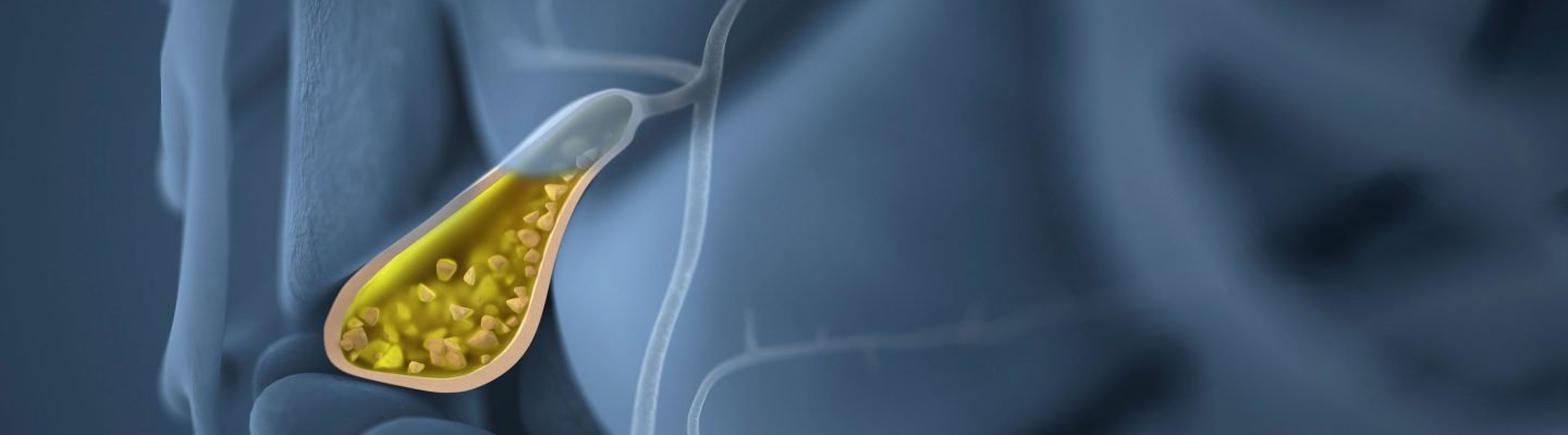 Polyp sa Loob ng Apdo (Gallbladder Polyps)