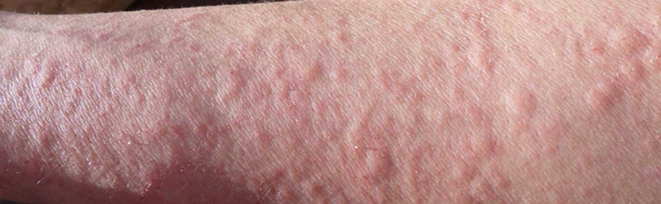 Alerhiya (Allergy)