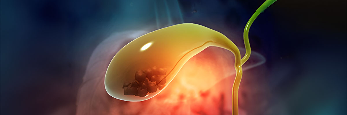 Bato sa Apdo (Gallstones)