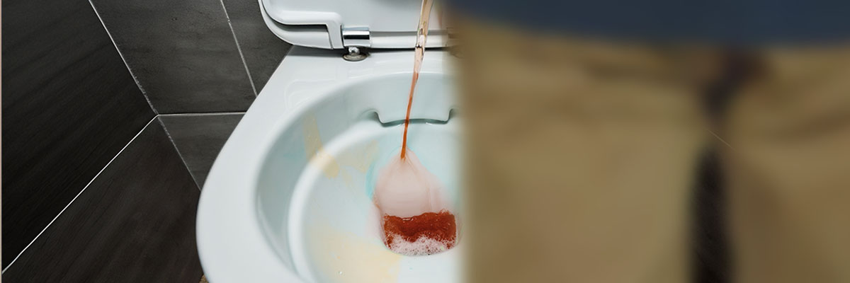 Dugo sa Ihi (Hematuria)