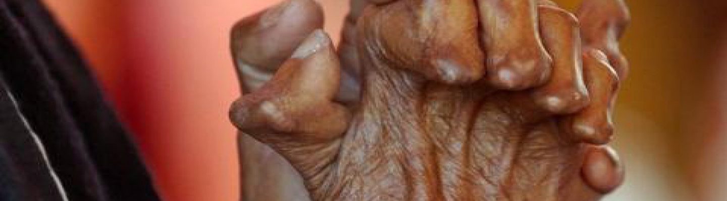 Ketong (Leprosy)