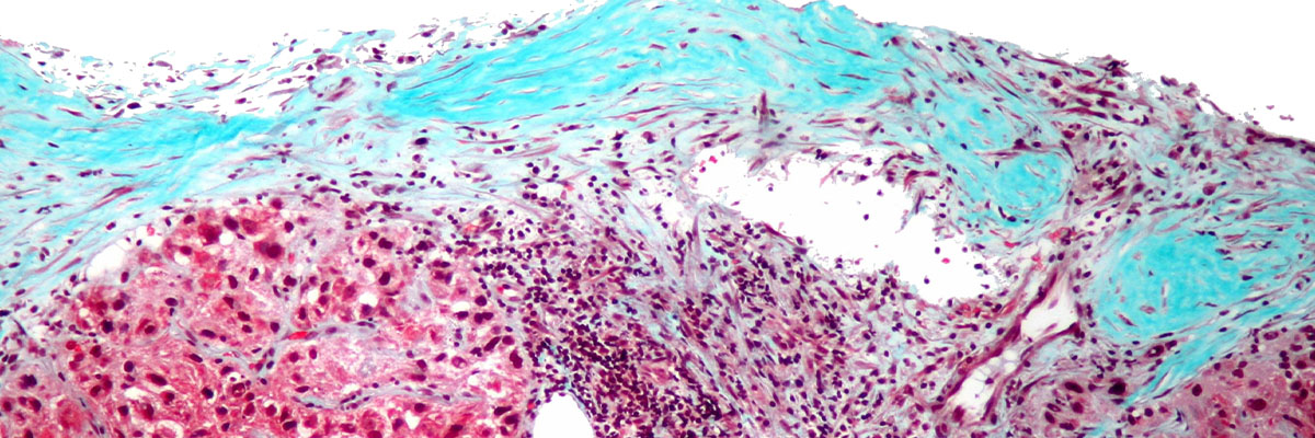 Kanser sa Atay (Liver Cancer)