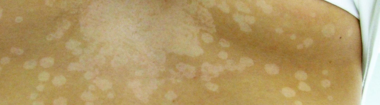 An-an (Tinea Versicolor)