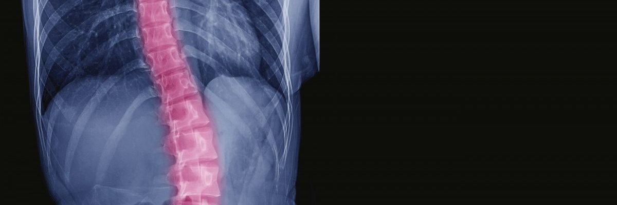 Scoliosis