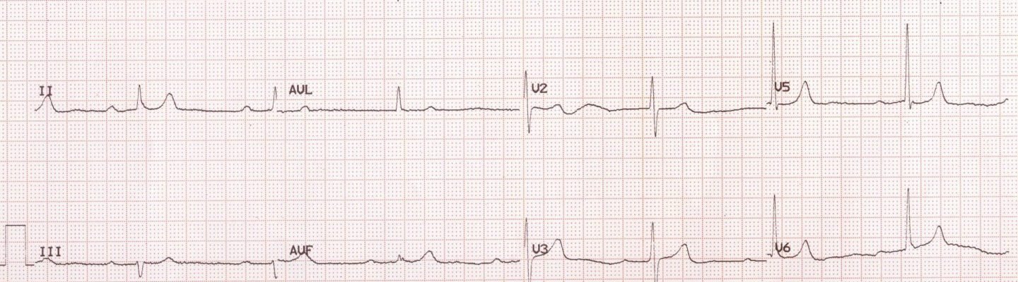Atrioventricular Block (Heart Block)