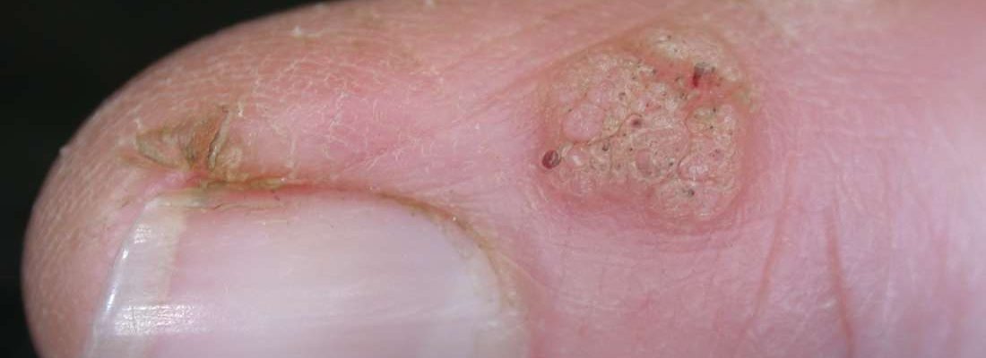 Kulugo (Wart)