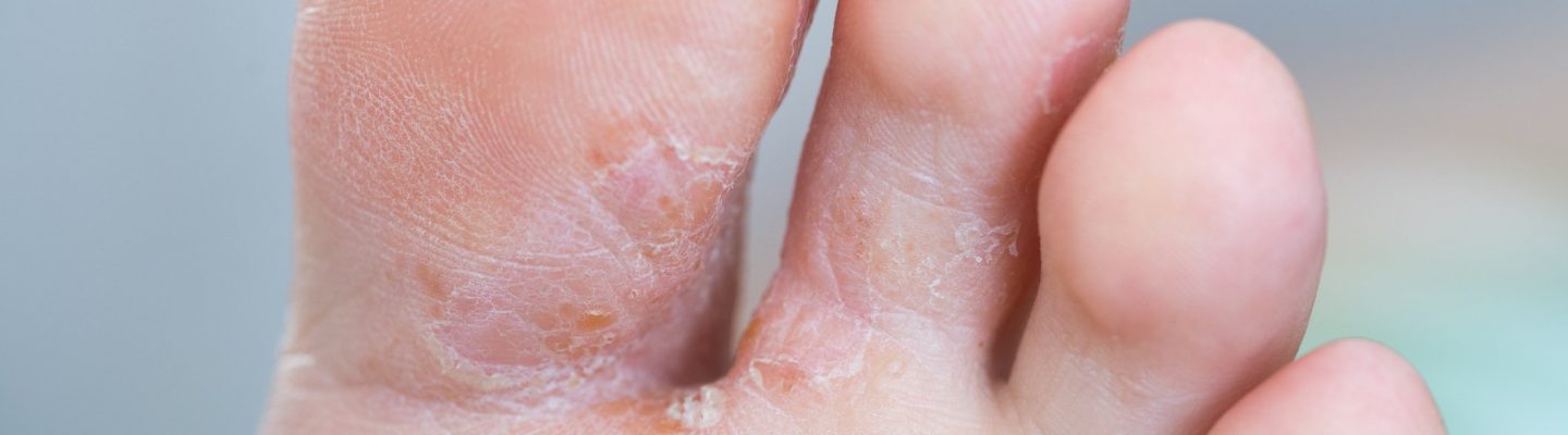 Alipunga (Athlete’s Foot)