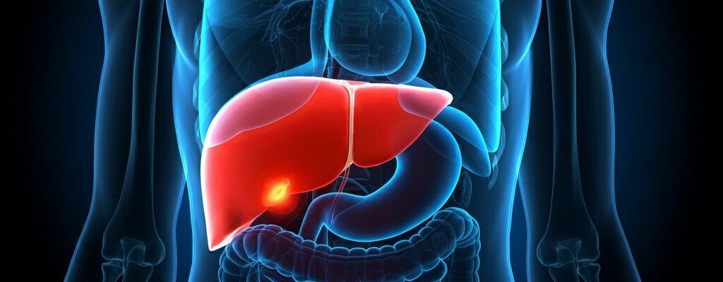 Cyst sa Atay (Liver Cyst)
