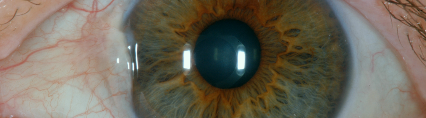 Pterygium