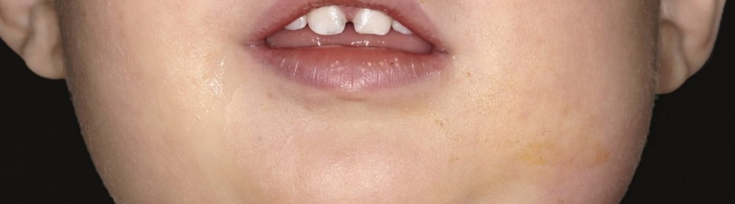 Beke (Mumps)