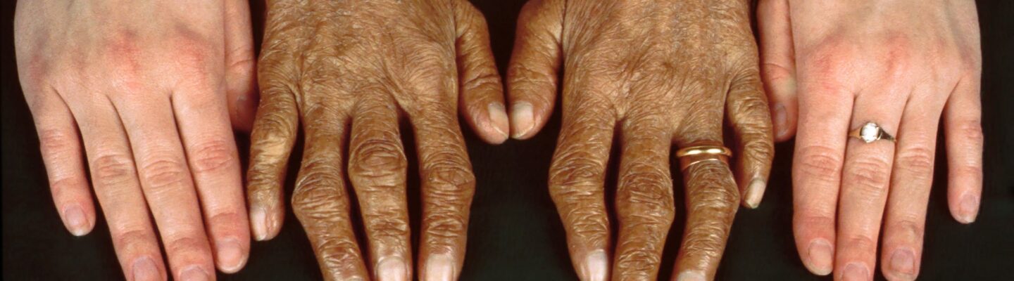 Hemochromatosis