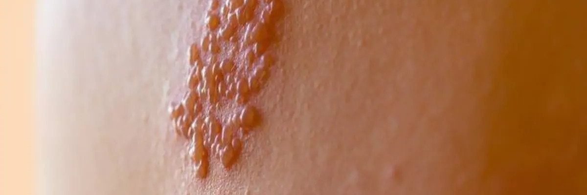 Herpes