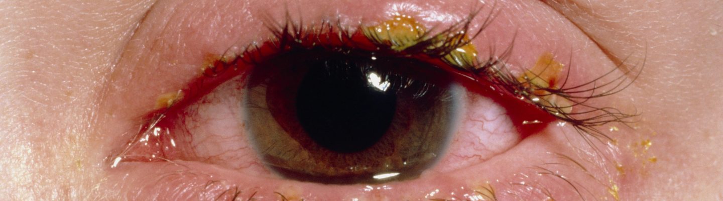 Pamamaga ng Talukap (Blepharitis)