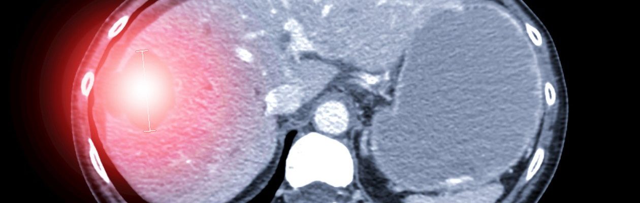 Cyst sa Atay (Liver Cyst)