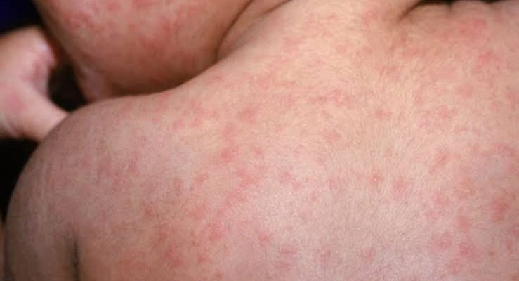 Tigdas (Measles)