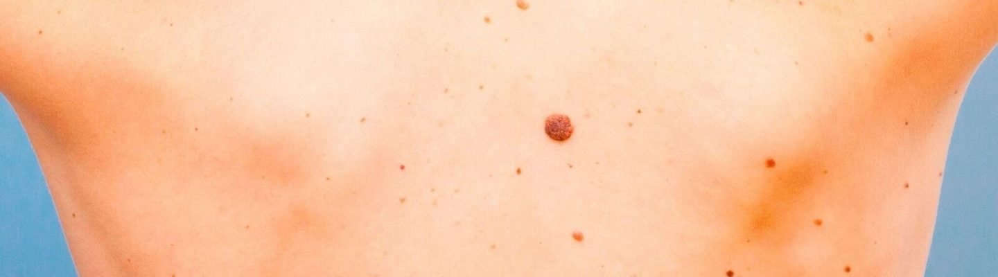 Kanser sa Balat (Skin Cancer)