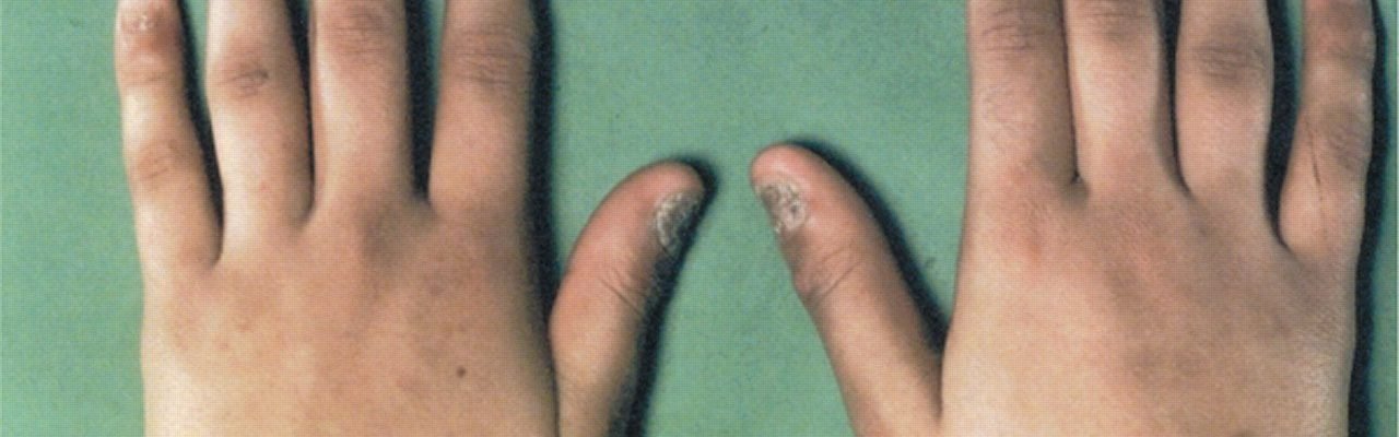 Addison’s Disease