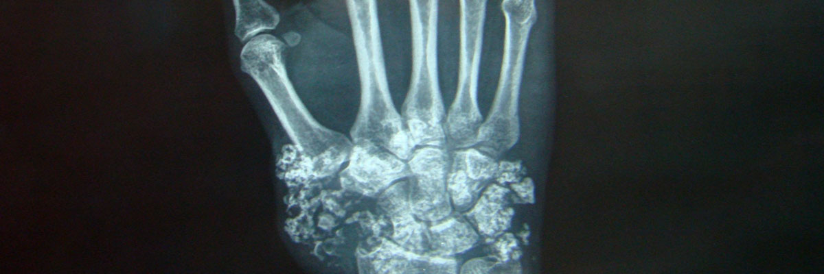 Kanser sa Buto (Bone Cancer)