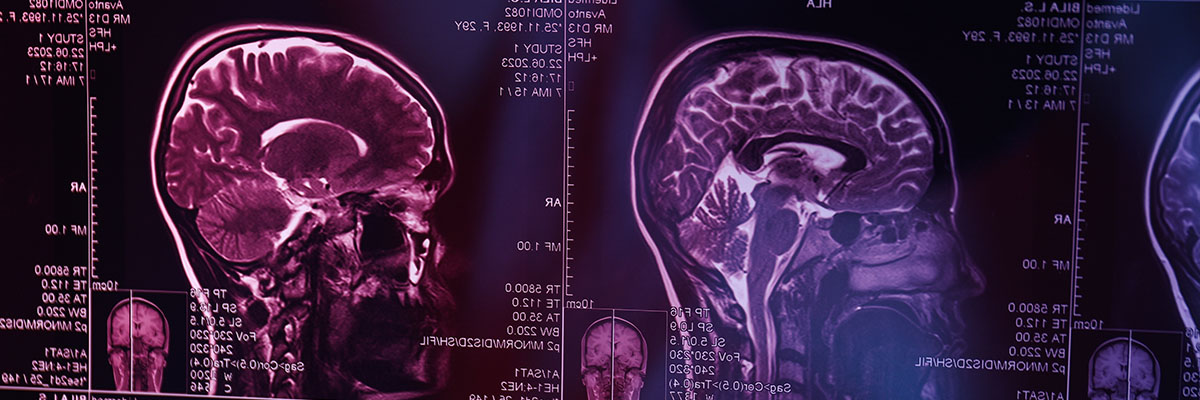 Kanser sa Utak (Brain Cancer)