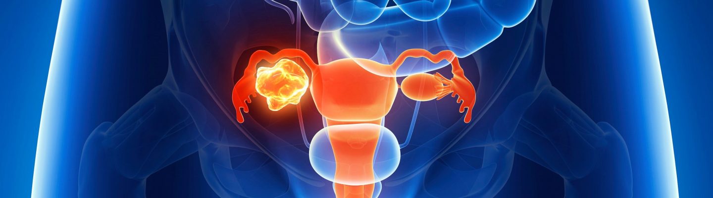 Kanser sa Obaryo (Ovarian Cancer)
