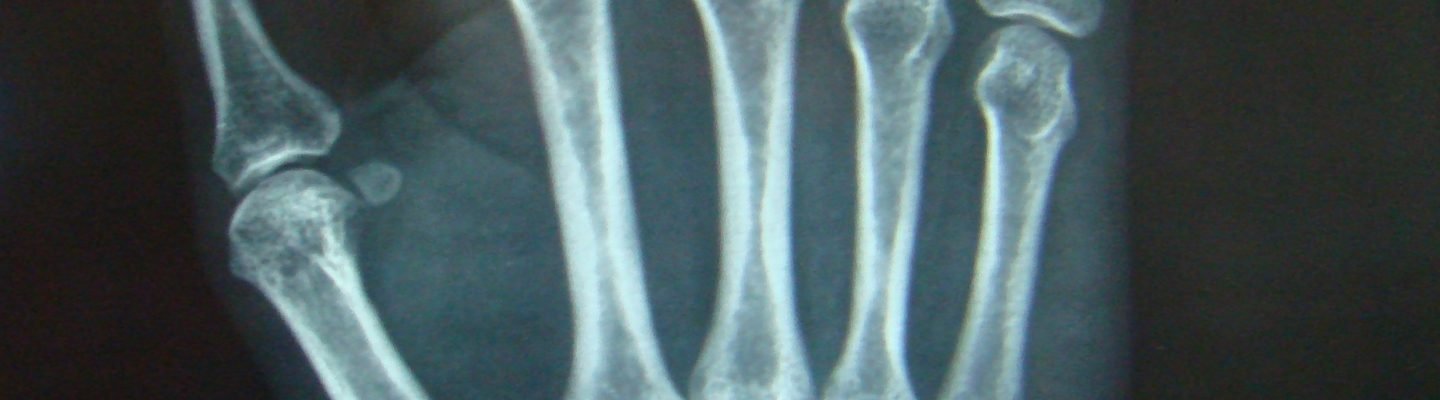 Kanser sa Buto (Bone Cancer)