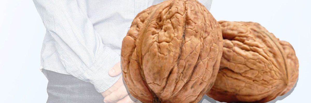 Kanser sa Bayag (Testicular Cancer)