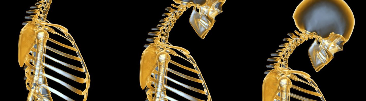 Paano makaiwas sa Osteoporosis?