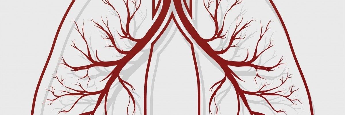Bronchiectasis