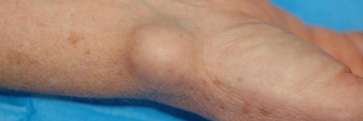 Ano ang gamot sa ganglion cyst?