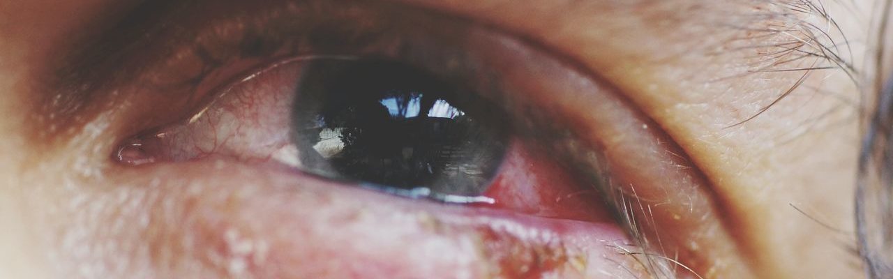 Masama ba ang sore eyes sa buntis?