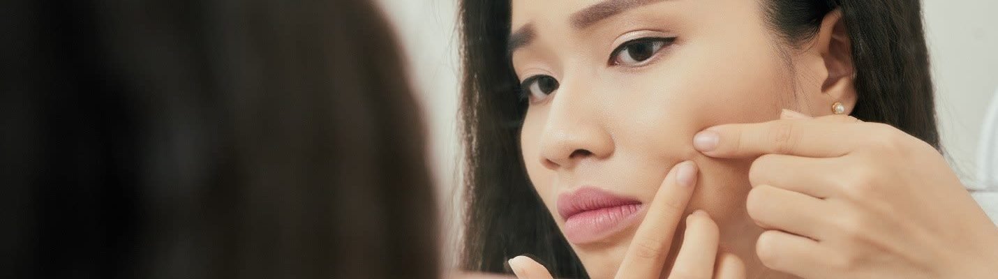 Ano ang gamot sa tigyawat o pimples (Acne)?