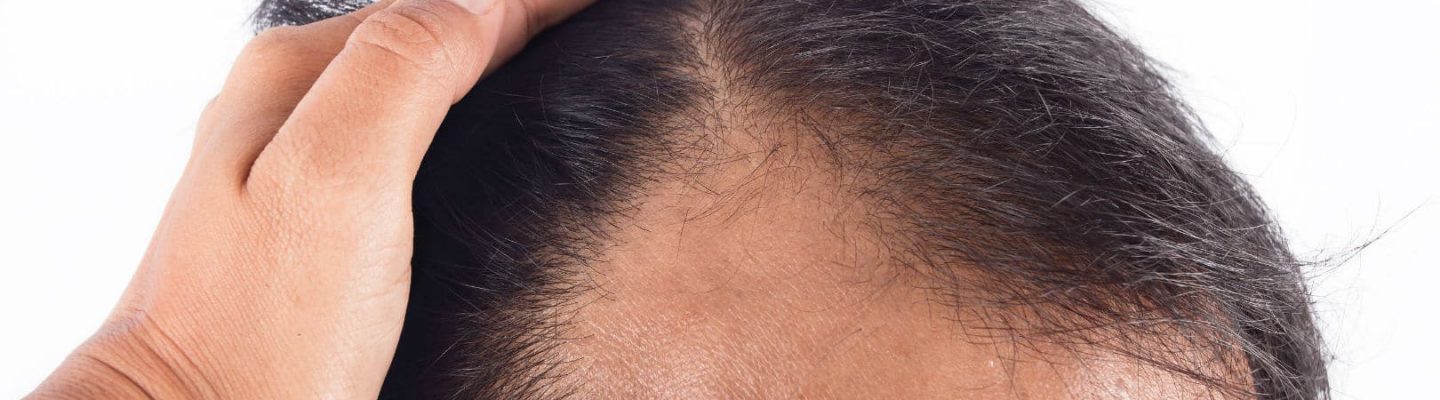 May gamot para pigilan ang buhok na nakakalbo?